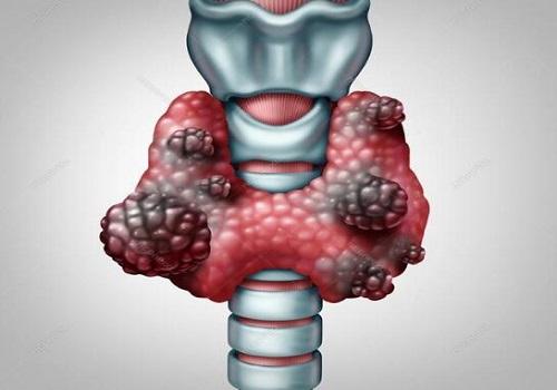 甲狀腺癌高發(fā)，是攝碘過多還是過度診斷？
