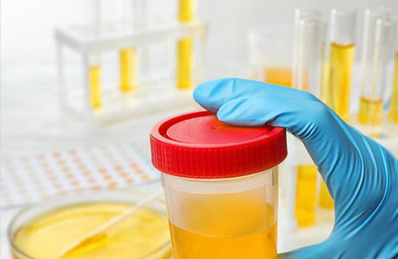 個體進(jìn)行尿碘監(jiān)測時(shí)的注意事項(xiàng)